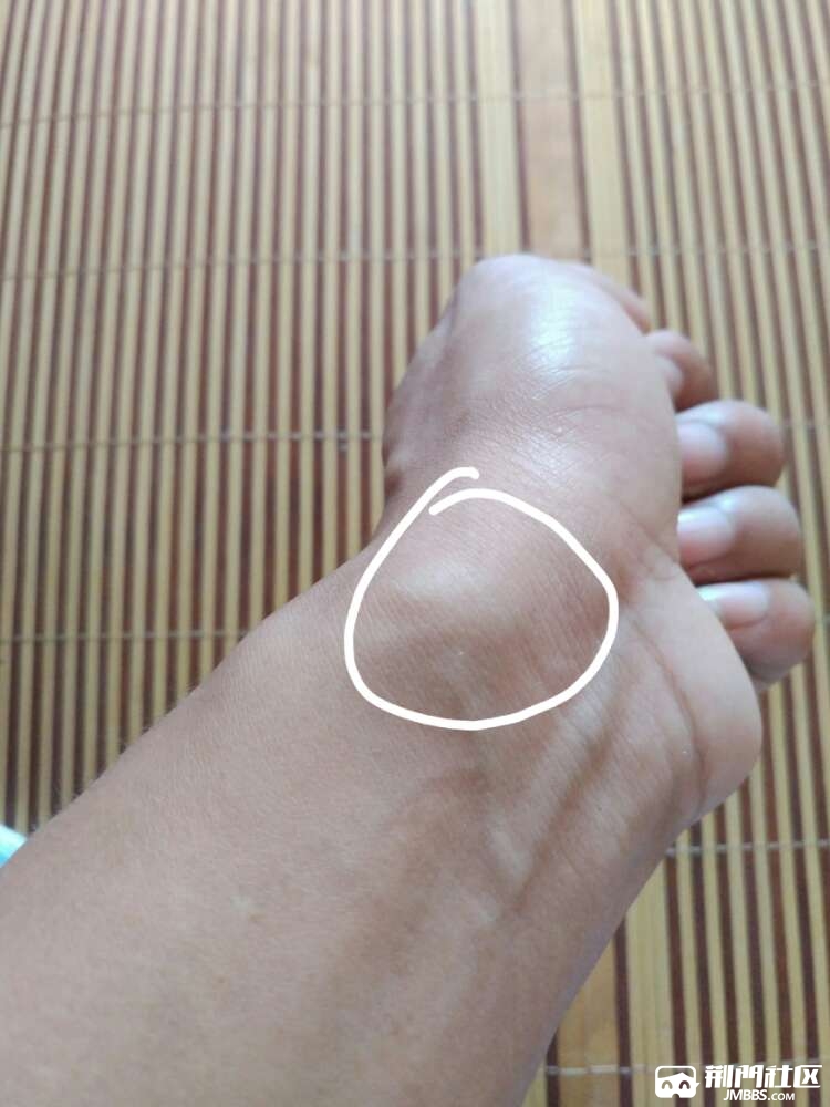 左手腕张个东西不疼不痒