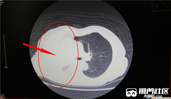 七旬老人反复咯血,右肺一度丧失功能,危在旦夕,多学科协作"双剑合璧"