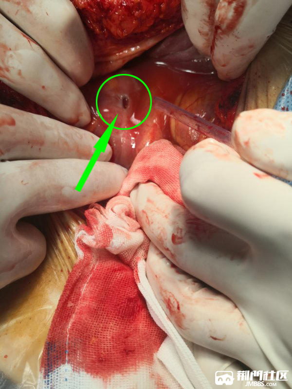 手术中,发现老太太的十二指肠球部前壁有一个直径约2cm的穿孔
