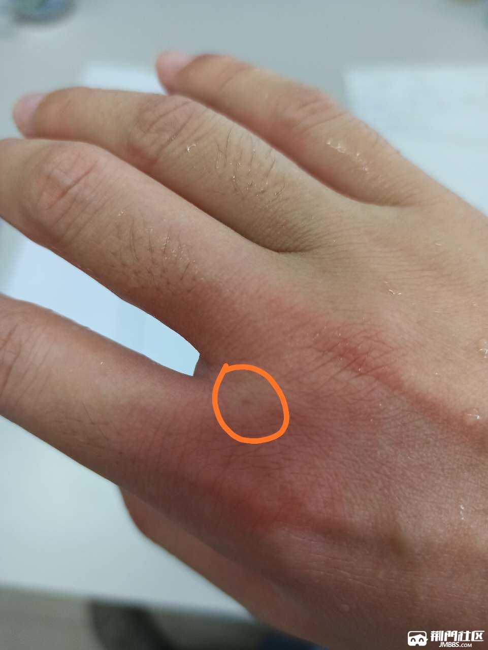 不小心被虫子蛰了,问下大家除了蜜蜂马蜂还有什么虫子蛰人