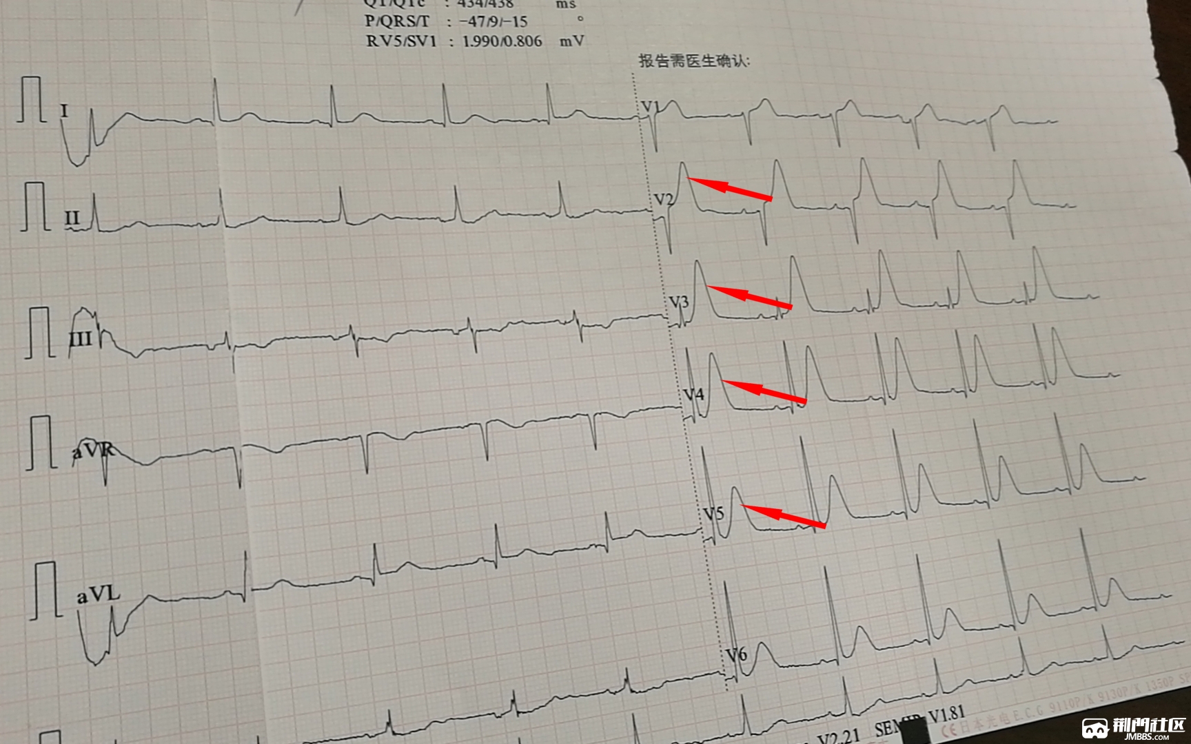 首次心电图胸导联t波异常高大(红箭头处),考虑急性心肌梗死