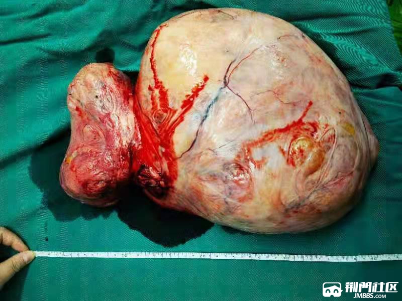 赵芬腹中取出的巨大肿瘤
