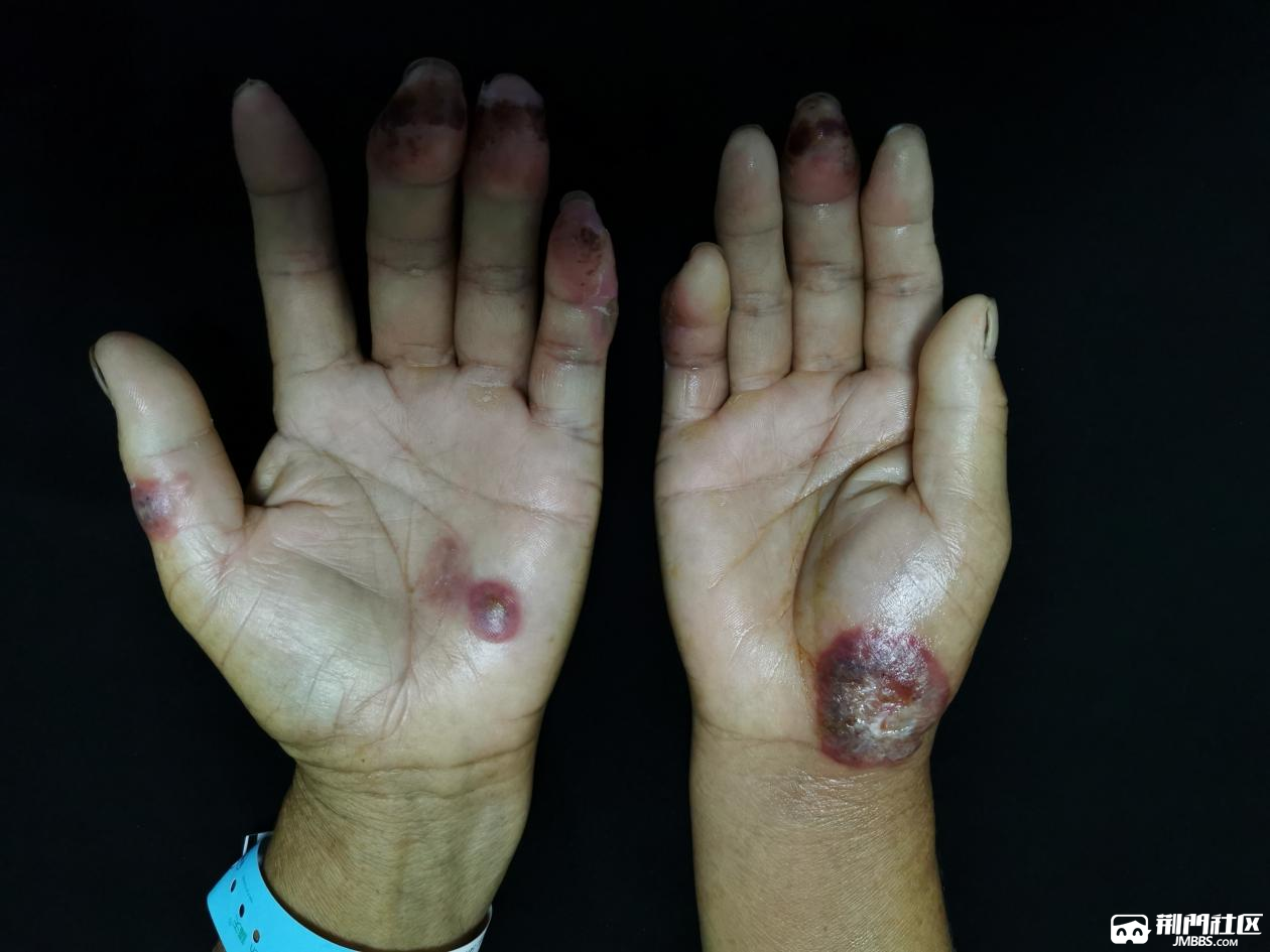 "怪病"久治不愈,病情愈演愈烈,皮肤科医生一见"终"情