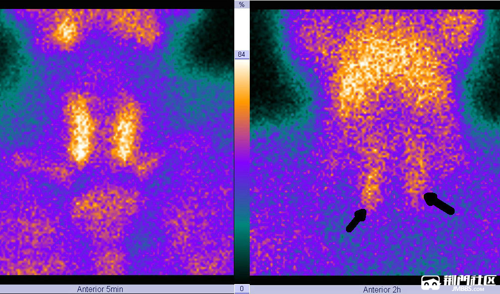 多学科接力,起博器"护心"全切甲状旁腺