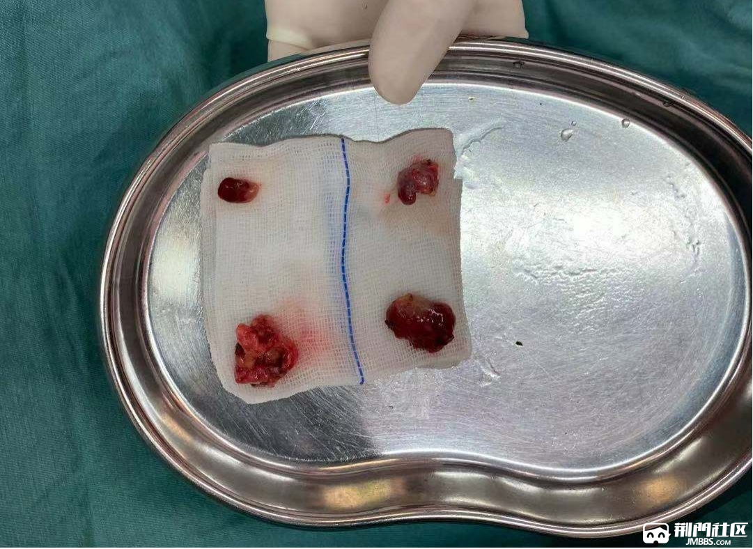 逐一切除的4个甲状旁腺(2个稍大些的为影像显示的增生甲状旁腺)