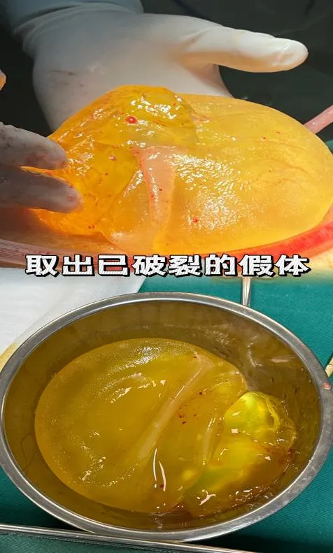女子隆胸假体破裂形如"果冻",医生提醒:超过"保质期"一定要查!